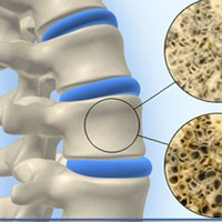 Δωρεάν μέτρηση οστικής πυκνότητας