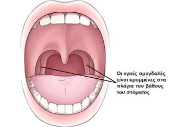 Οξεία Αμυγδαλίτιδα