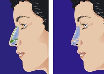 Λειτουργική Ρινοπλαστική: Πόσο βοηθάει την εικόνα μας;