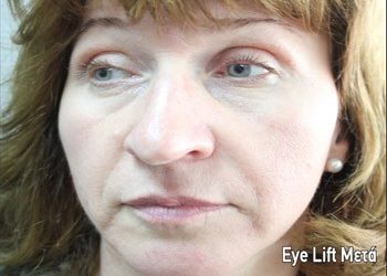 Βλεφαροπλαστική χωρίς νυστέρι