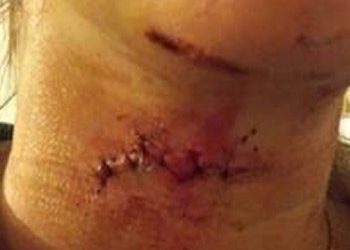 Γυναίκα στο Αγρίνιο παραλίγο να χάσει τη ζωή της από επίθεση γερακιού