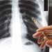 Εξετάστηκαν δωρεάν 30 καπνιστές με σπιρομέτρηση