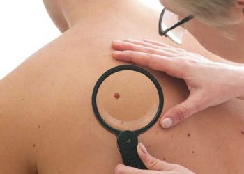 Η αλφαβήτα του μελανώματος