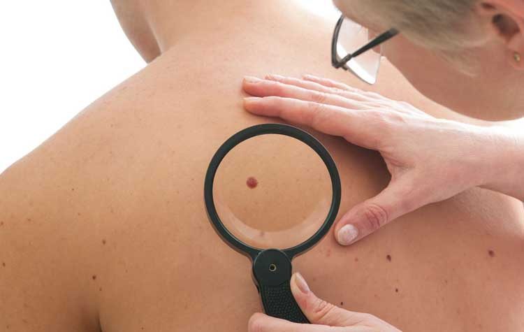 Η αλφαβήτα του μελανώματος