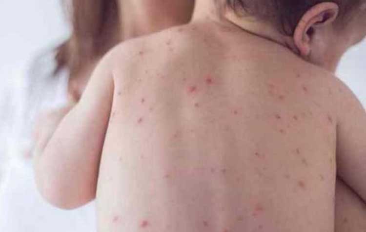 Επιστολή ΙΣΑ στην Ελληνική Παιδιατρική Εταιρία για την αντιμετώπιση των κρουσμάτων ιλαράς