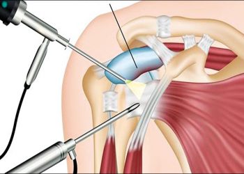 Αρθροσκόπηση ώμου: Η ελάχιστα επεμβατική τεχνική που δίνει λύση στις παθήσεις της περιοχής