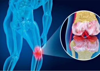 Οστεοαρθρίτιδα γόνατος και νέες µέθοδοι αντιµετώπισης