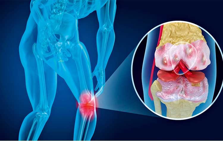 Οστεοαρθρίτιδα γόνατος και νέες µέθοδοι αντιµετώπισης
