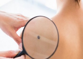 Δωρεάν έλεγχος σπίλων (ελιών) από τον Δήμο την Παρασκευή 25/6