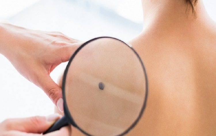 Δωρεάν έλεγχος σπίλων (ελιών) από τον Δήμο την Παρασκευή 25/6