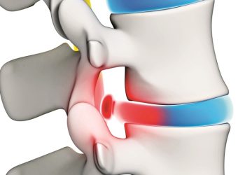 Οζονοθεραπεία: Θεαµατικά αποτελέσµατα στην αντιµετώπιση του πόνου
