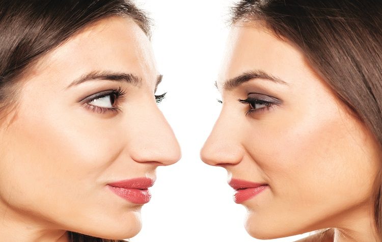 Ρινοπλαστική: Ποια προβλήµατα µπορεί να επιλύσει