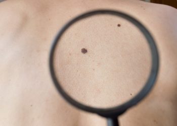 Έναρξη λειτουργίας του δερματολογικού ιατρείου με δωρεάν έλεγχο για το μελάνωμα