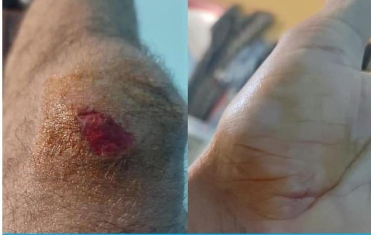 «Χαλάνδρι Ενάντια»: «Αποτρόπαια επίθεση φασιστοειδών σε μετανάστη εργάτη»