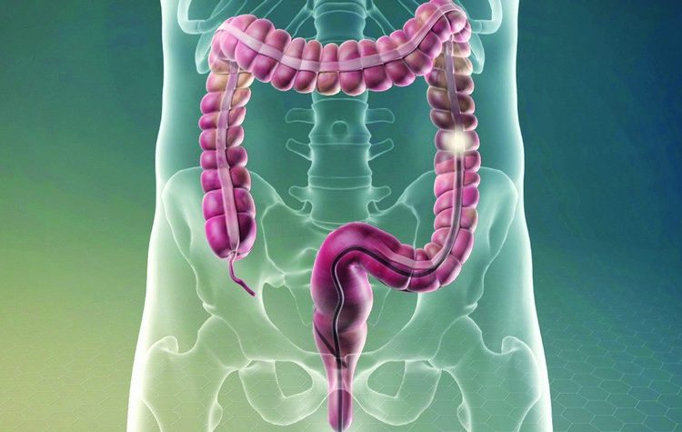 Κολονοσκόπηση: Μια εξέταση που σώζει ζωές