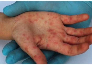 Κρούσματα ιλαράς: Αρρώστιες… από τα παλιά