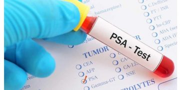 Δωρεάν προληπτικές εξετάσεις αίματος PSA για άνδρες 40–60 ετών στα Δημοτικά Ιατρεία